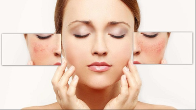 Hỏi đáp: Có nên trị nám bằng kem trị nám không? Hỏi đáp: Có nên trị nám bằng kem trị nám không?