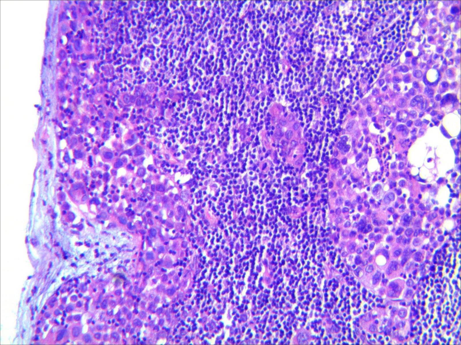 Causas del Ganglio Axilar: ¡Descúbrelas! Ganglio axilar causas