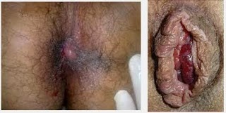 Ambeien Atau Hemoroid Ambeien Atau Hemoroid