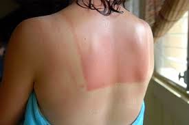 Health Tips for Sunburn Soothing Using 10 Home Remedies 