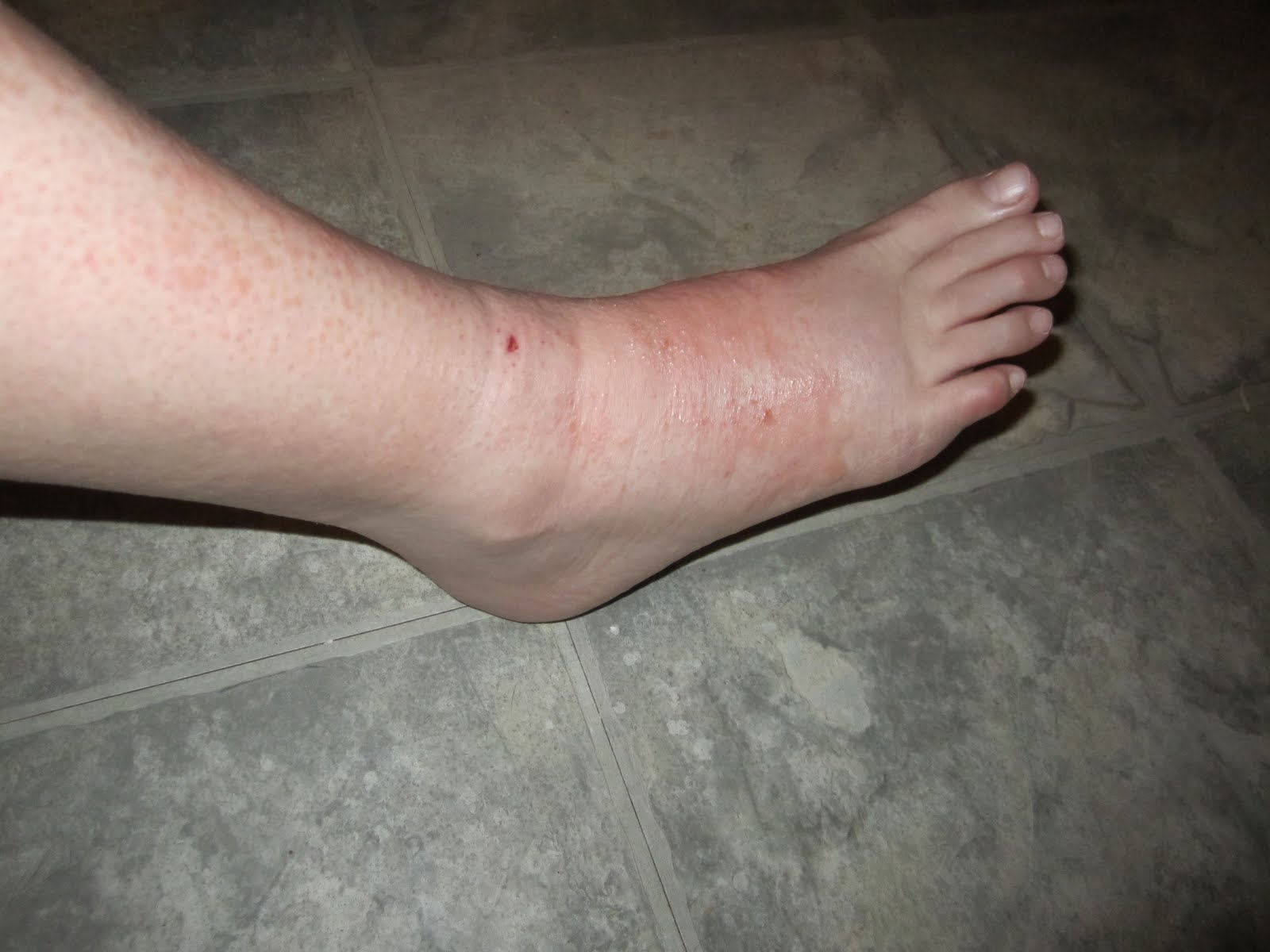 Swollen Leg Water Retention Red Rash 48
