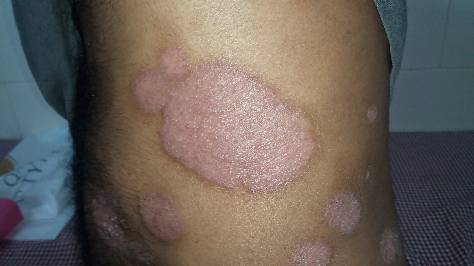can psoriasis be cured by allopathy