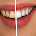 सिर्फ 5 दिनों में दांतों का पीलापन दूर करके पायें मोतियों जैसे चमकदार दांत | Teeth Whitening Tips