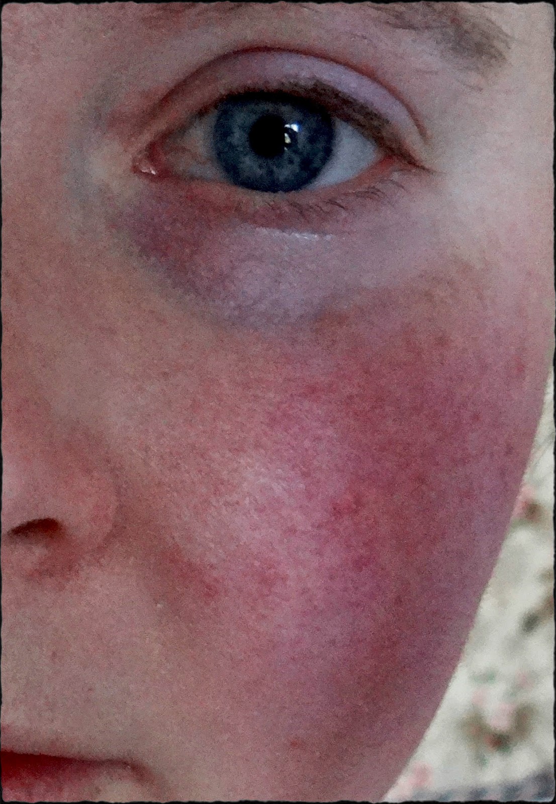 Scarlet Letters, dealing with vascular rosacea, face flushing, burning