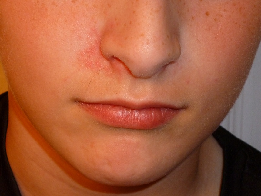 dermatitis around nose