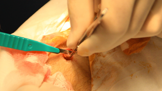 Watchers 8 Exclusive - Implant Removal with Dr. Leir. Commentary & Analysis by L. A. Marzulli.