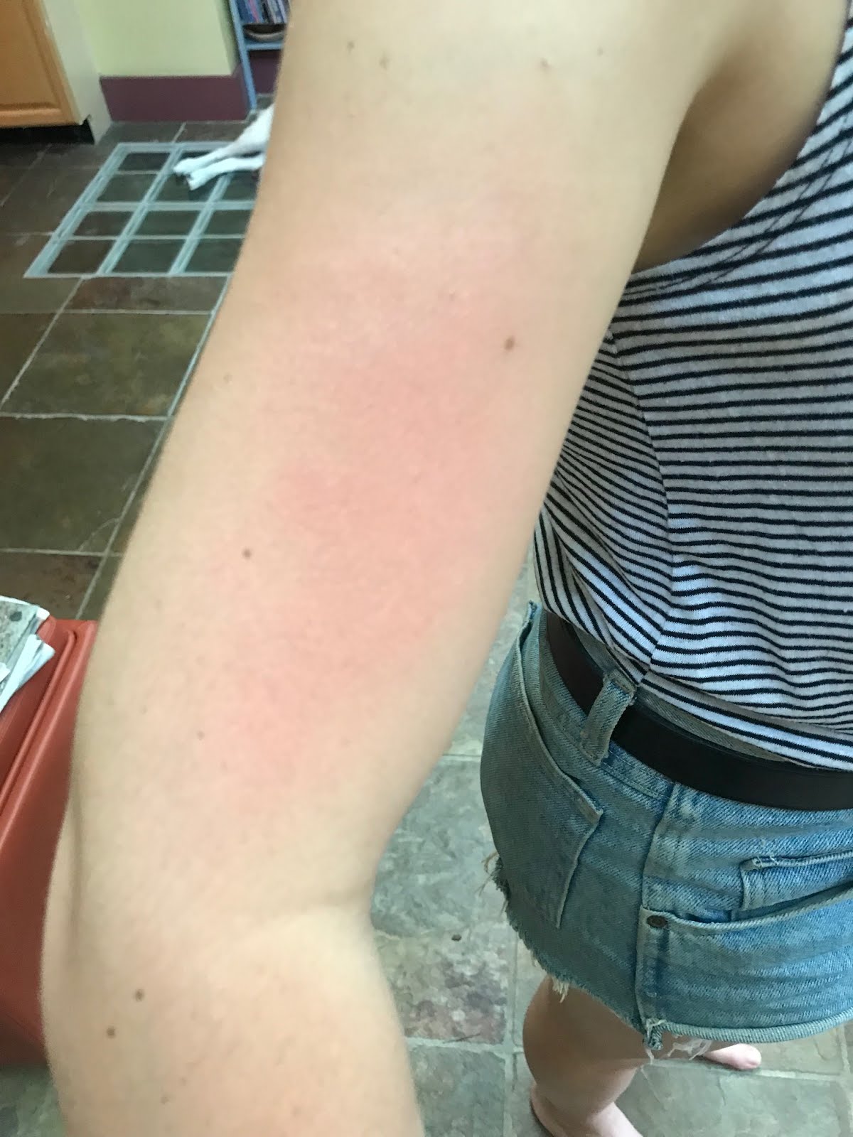 WheelsandEats Don't Be Rash Get Skin Relief