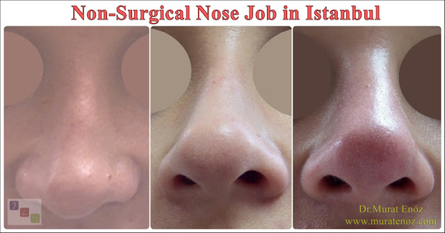 Nose filler injection video - Non-surgical nose job in İstanbul - Non surgical nose job with filler in İstanbul - Non-surgical rhinoplasty in İstanbul - Nose tip filler augmentation in İstanbul - Nose filler injection in Turkey - The 5 Minute Nose Job in İstanbul - Turkey - Non-surgical nose job in Istanbul - Non-surgical nose job istanbul - Nose filler injection Turkey - Injectable nose job - Liquid rhinoplasty