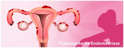 Tratamento da Endometriose