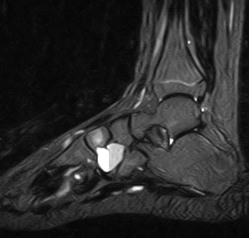Aneurysmal Bone Cyst Medial Cueniform Mri Sumers Radiology Blog