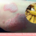 If You Have Wrinkles  Warts or Psoriasis Then Must Try Banana Peels