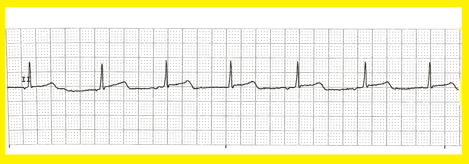Various Accelerated Junctional Rhythms