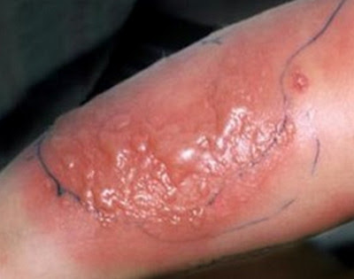 de que da la celulitis infecciosa