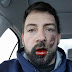 E-cigarettes explodes in man's mouth while he is smoking it