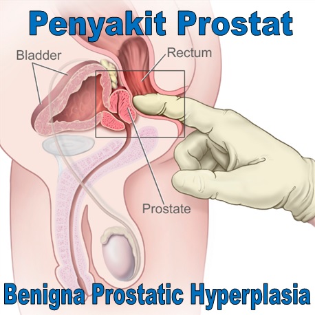 Jóindulatú prosztata megnagyobbodás (Benignus prostata hyperplasia: BPH) (x)