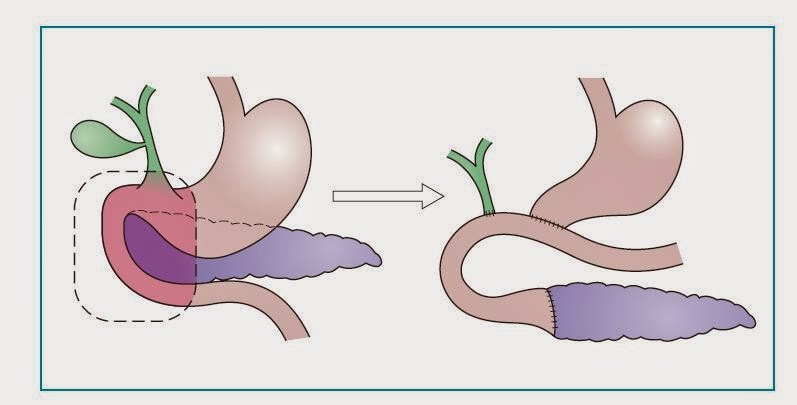 Step Van Whipple Procedure Steps