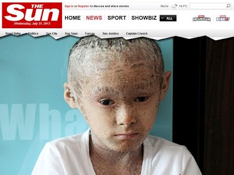 Criança sofre de doença rara com pele que lembra escamas