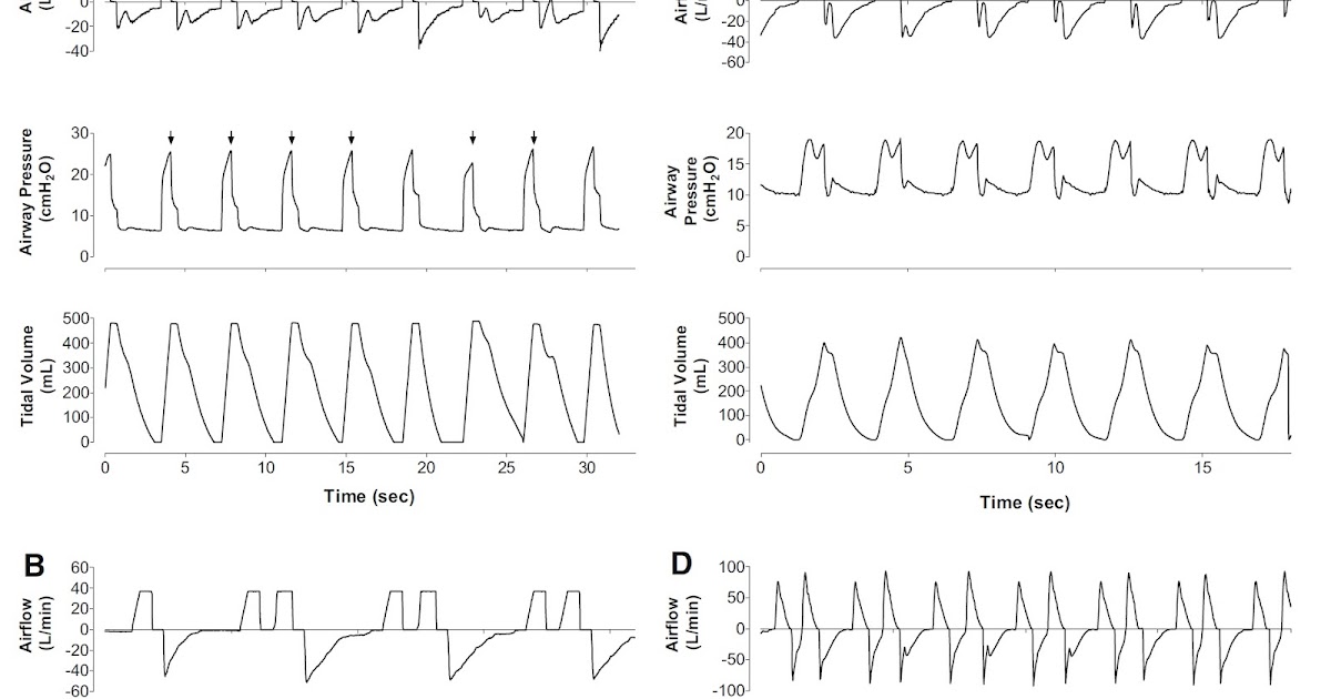 急性期医療コレクション リバーストリガーをグラフィックモニタで診断する