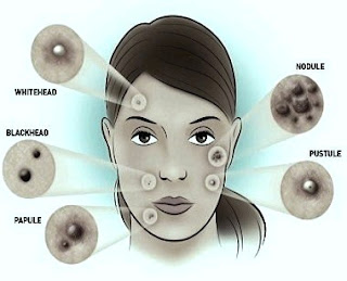 acne treatment