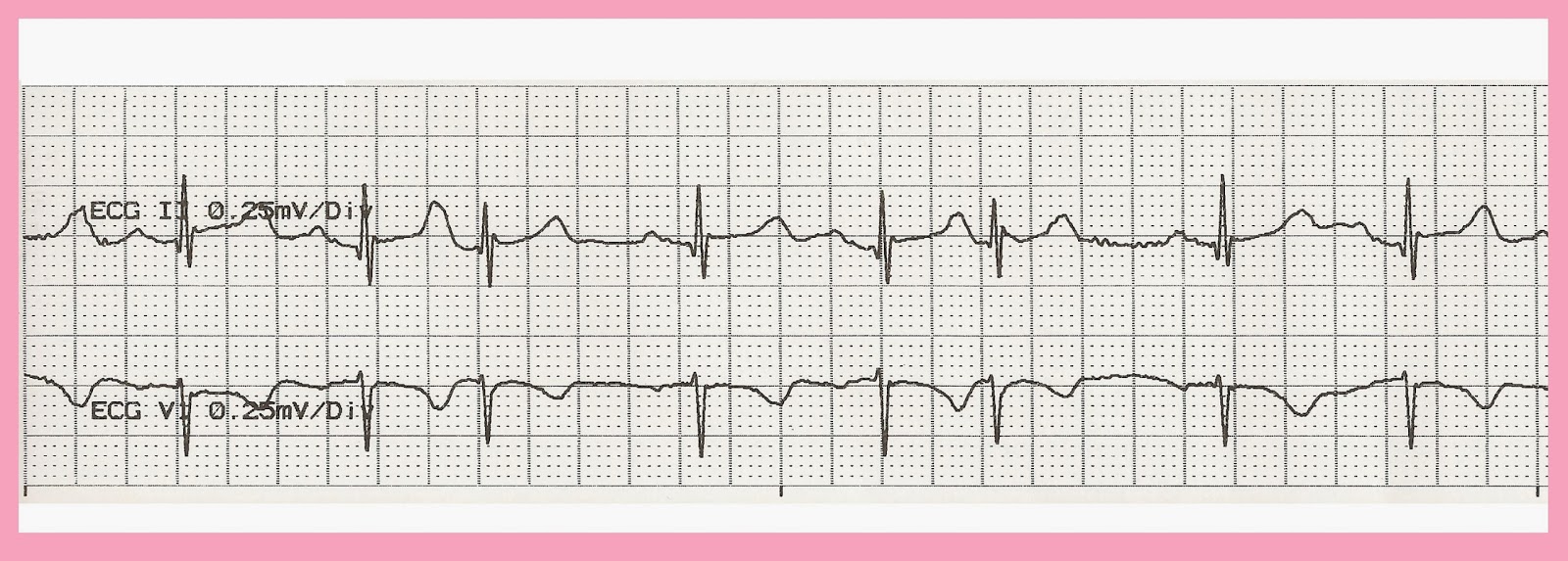 Float Nurse EKG Rhythm Strip Quiz 198