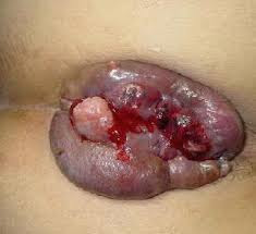 Foto Klinik Wasir Safute