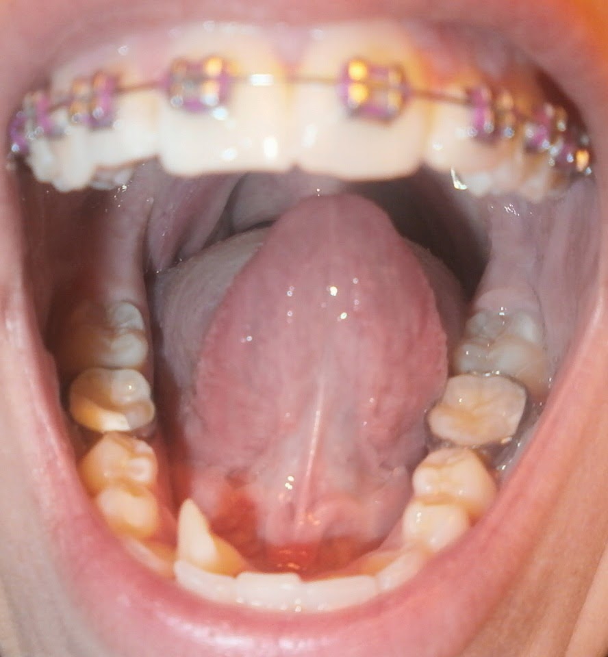 El Alambre De Los Brackets Me Lastima
