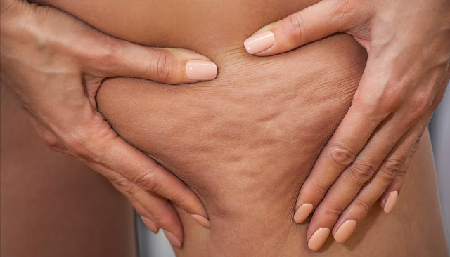 Cellulite, everything you need to know Cellulite, everything you need to know