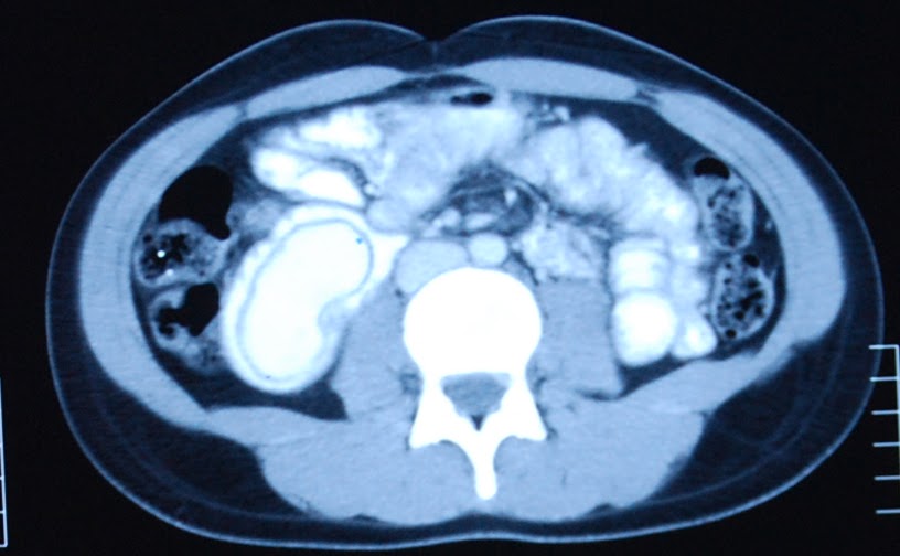 Windsock deformity Unusual Cause of gastric
