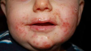 A child has severe rashes on the face photos