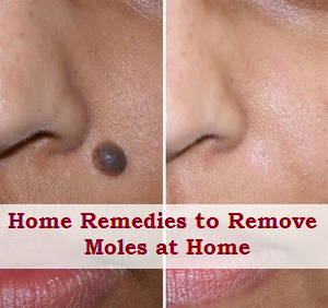 4 Home Remedies to Remove Moles at Home 4 Home Remedies to Remove Moles at Home