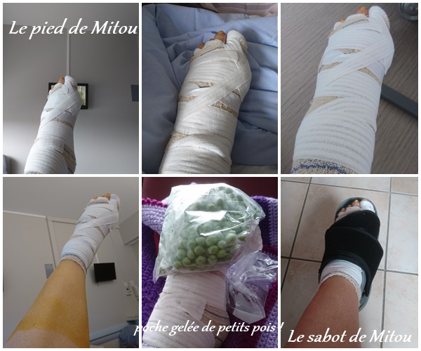 Marcher Après Une Arthrodèse Du Pied Mitou et son arthrodèse