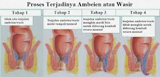 Pengobatan Ampuh Untuk Penyakit Wasir