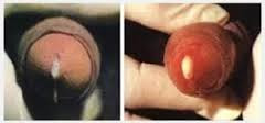 Obat Kencing Nanah Untuk Wanita Obat Kencing Nanah Untuk Wanita