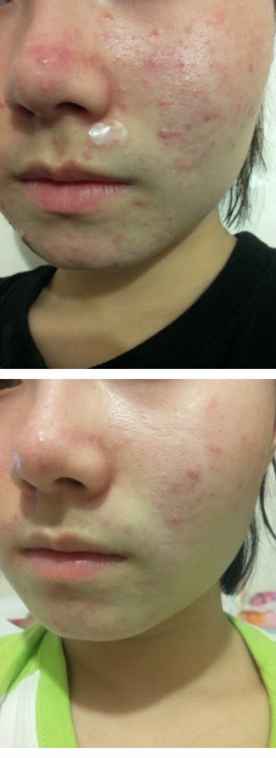 [COSMETICS MATERIAL] Raw material effective for acne? Houttuynia