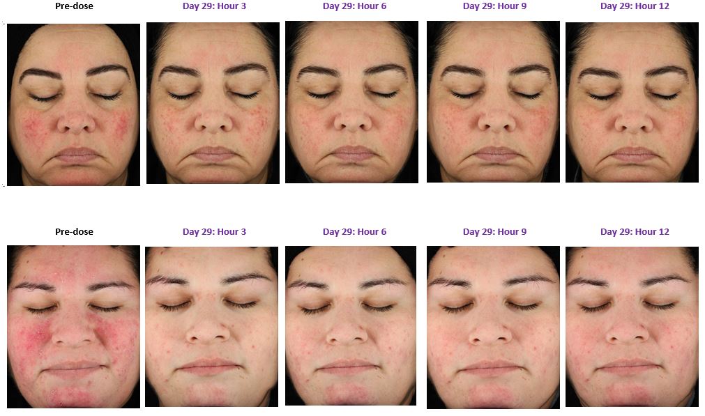 Scarlet Letters, dealing with vascular rosacea, face flushing, burning and the rest Rhofade