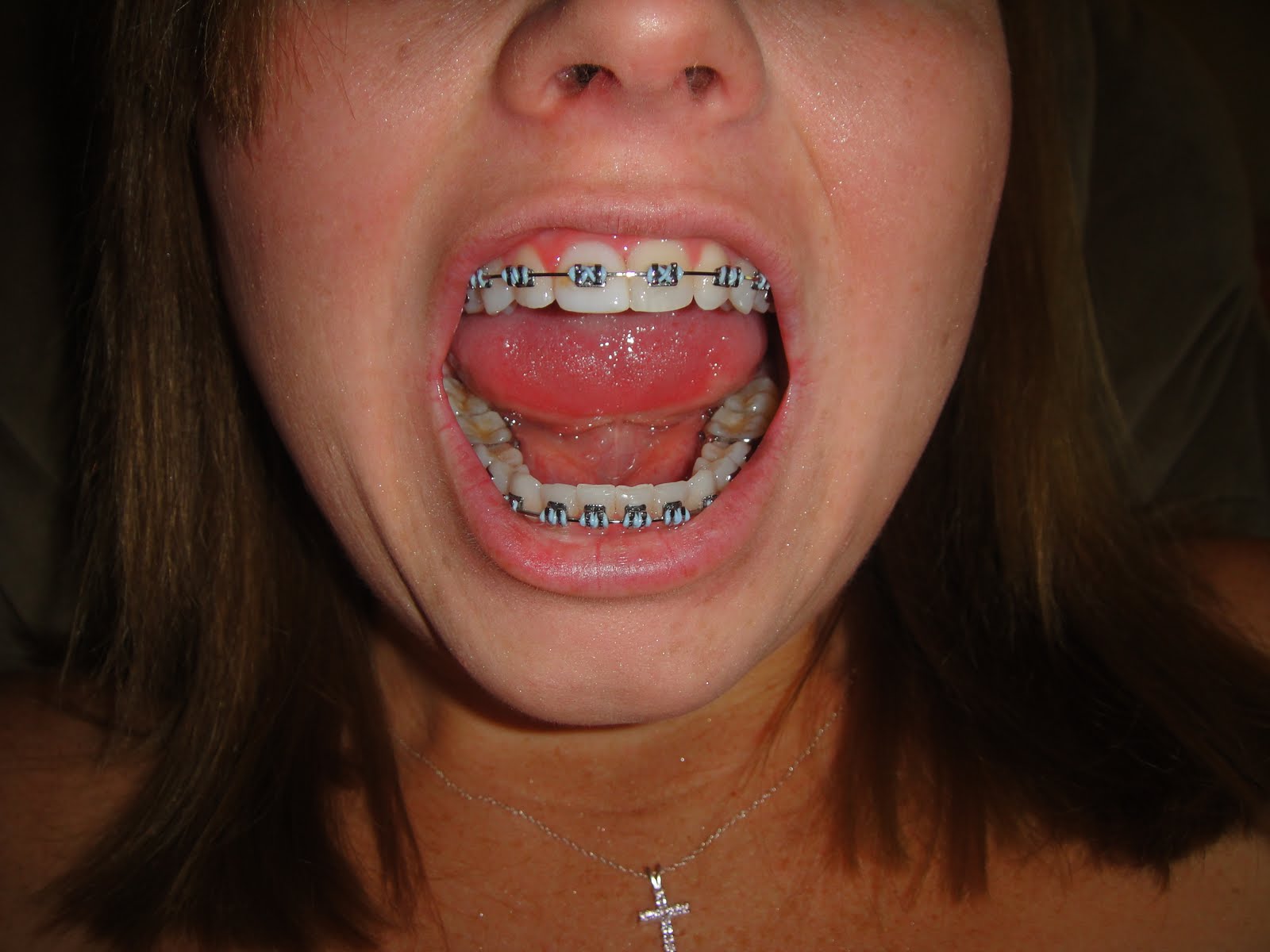 getting braces bad needs tooth inward turn