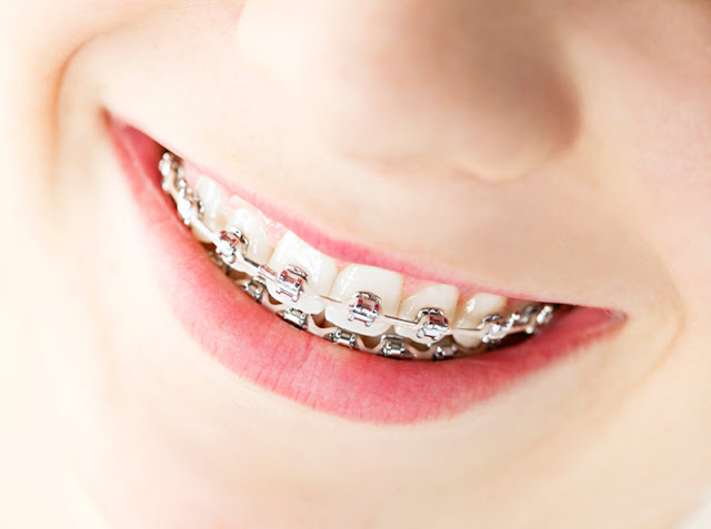 orthodontic treatment for irregular teeth wearing braces treatment done at jamnagar