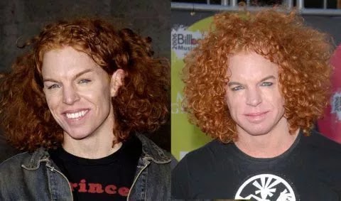 Before And After Celebs Plastic Surgery Disasters Before And After Celebs Plastic Surgery Disasters