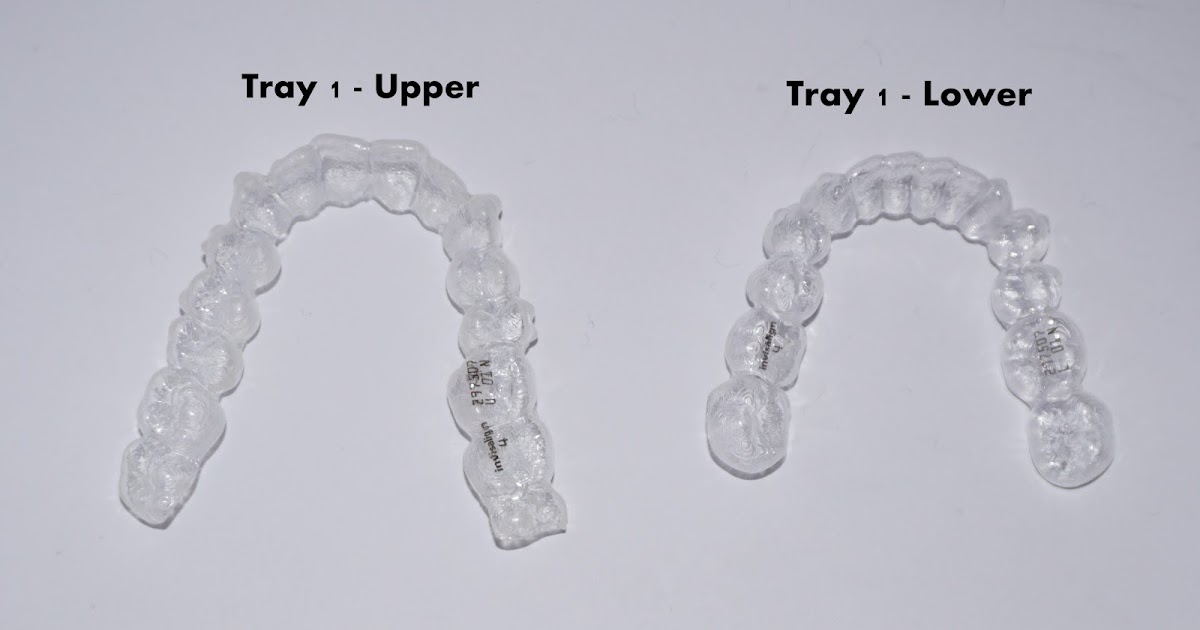 Invisalign Tray 1 & 2 Porty's Diary