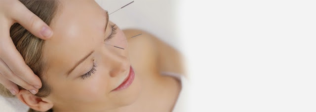 Acupuntura estetica Acupuntura en rostro para mejorar apariencia