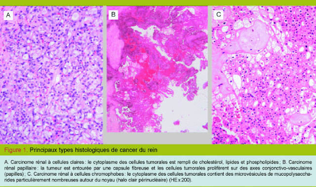 #thelancetoncology #carcinomerénalnonàcellulesclaires #everolimus #sunitinib Everolimus versus sunitinib chez patients atteints carcinome rénal cellules claires métastasé (ASPEN) étude phase multicentrique randomisée ouvert