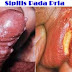Obat utk sifilis thumbnail