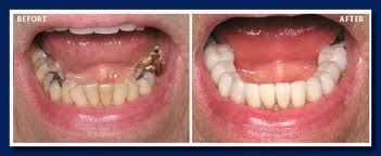 dental crowns Alabama