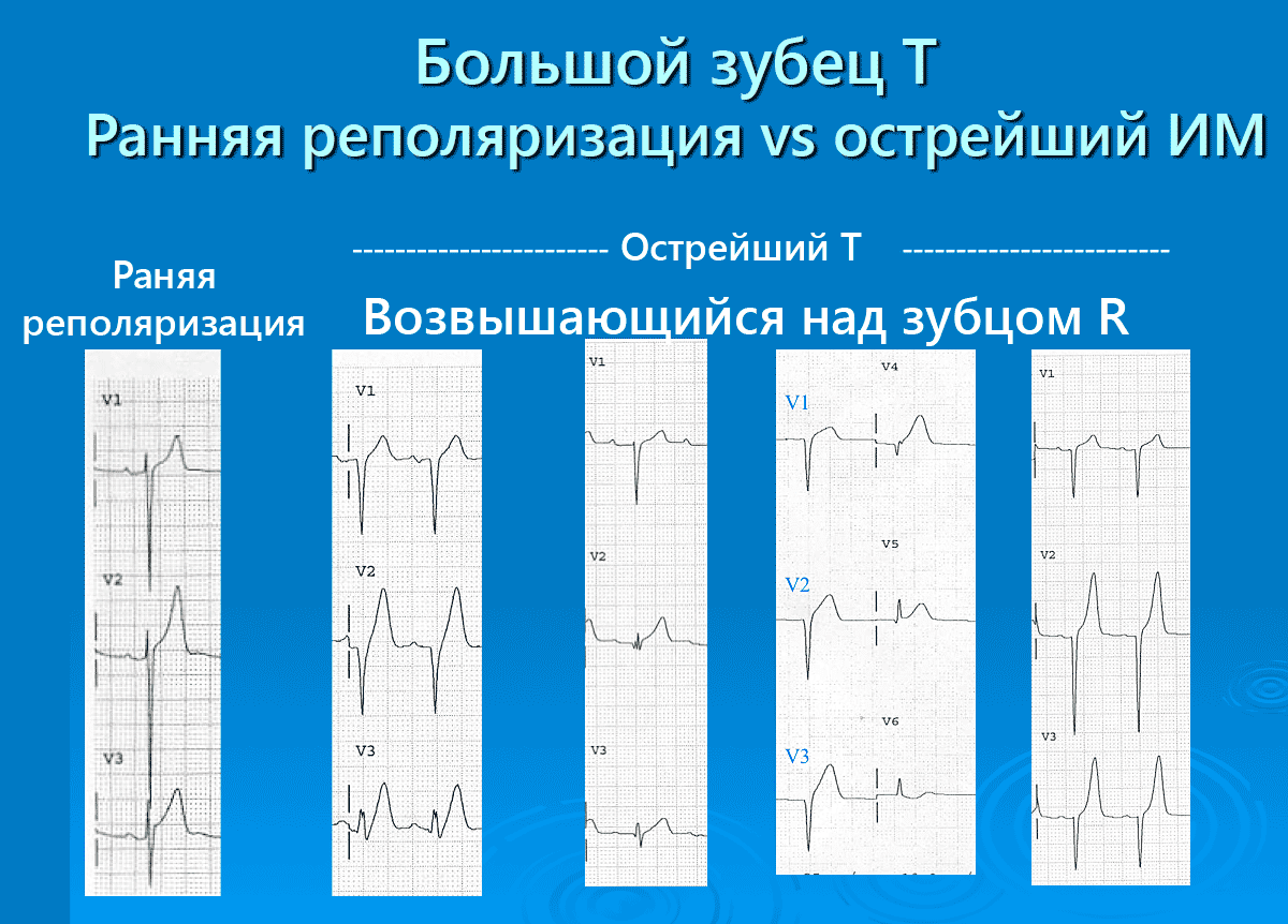Высокий зубец т на экг в v2 v3. V4 v5 v6 на экг. Глубокий зубец s на экг на v2 v3. Двухфазный зубец т на экг. Экг отрицательный зубец т в v1-v3.