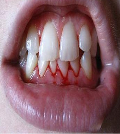 chảy máu chân răng có nguy hiểm không chảy máu chân răng có nguy hiểm không