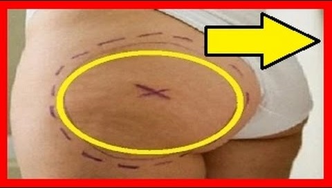 como eludir las estrias blancas linear unit los gluteos remedios caseros