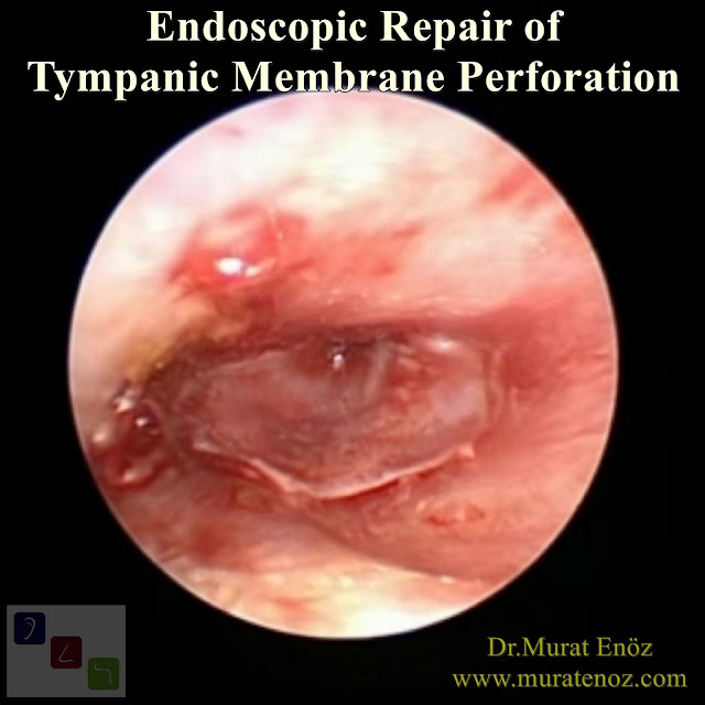 Endoscopic Eardrum Repair - Endoscopic Repair of Tympanic Membrane Perforation - Transcanal Endoscopic Myringoplasty - Endoscope Assisted Myringoplasty - Endoscopic Myringoplasty - Endoscopic-Assisted Myringoplasty - Endoscopic Eardrum Hole Surgery