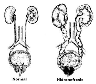 Hidronefrosis obstruccion en ureteres, provocando hidronefrosis