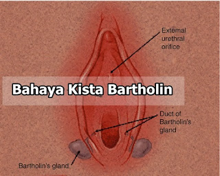 Bahaya Kista Bartholin Yang Harus Diketahui Dan Obatnya, 5 Bahaya Kista Bartholin Jika Tidak Di Operasi - LIHAT DISINI!, Ciri Ciri Penderita Kista Bartholin | Solusi Tepat