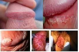 Cara Menghilangkan Bintik Kasar Di kelamin Cara Menghilangkan Bintik Kasar Di kelamin